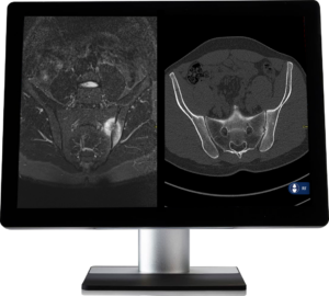 RheumaFinder AI software integration with PACS for CT bone lesion detection